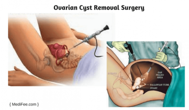Clínica para Cirurgia para Cistos de Ovário Butantã - Clínica para Cirurgia para Cistos de Ovário Clínica para Cirurgia para Cistos de Ovário Butantã - Clínica para Cirurgia para Cistos de Ovário