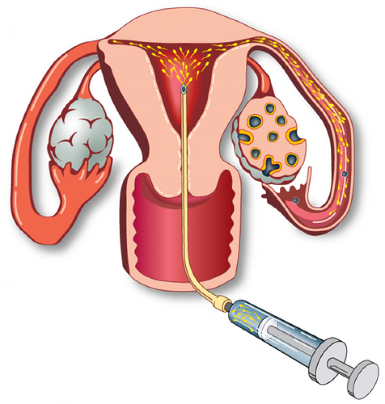 Onde Encontrar Clínica de Inseminação Artificial Jardim Aeroporto - Centro de Reprodução Humana Onde Encontrar Clínica de Inseminação Artificial Jardim Aeroporto - Centro de Reprodução Humana